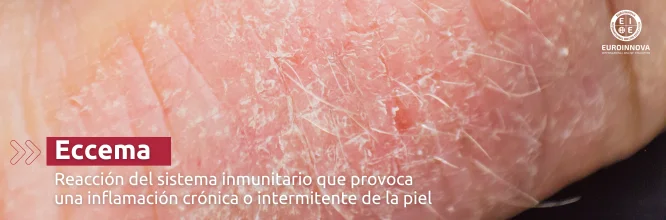 ¿Qué es el eccema y por qué aparece?