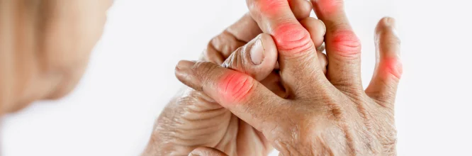 Artritis gotosa: qué es y síntomas principales